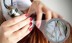 Techniques et critères de choix pour une greffe de cheveux réussie